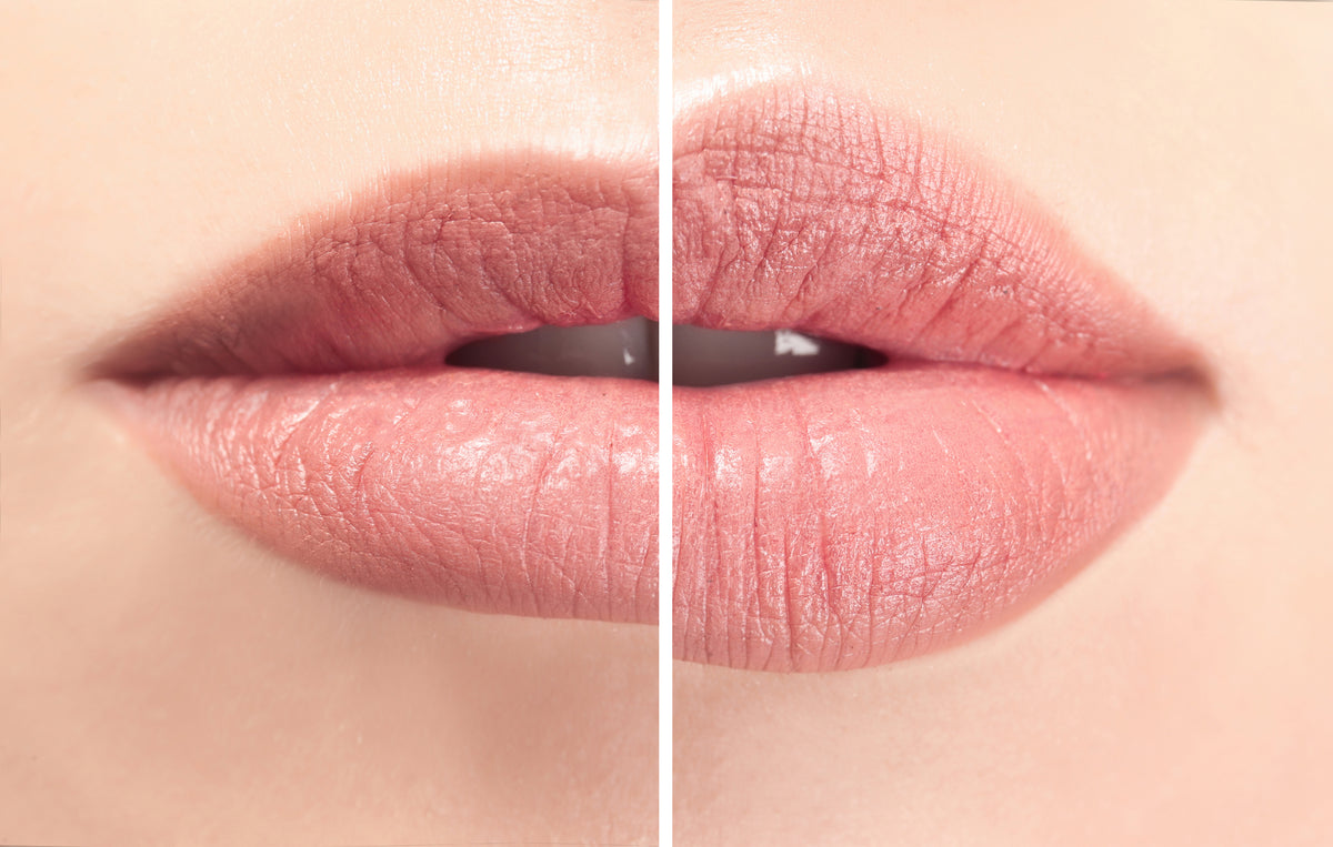 Restylane Defyne/Lyft/Refyne