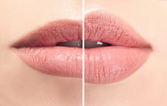 Lip Filler Restylane Kysse