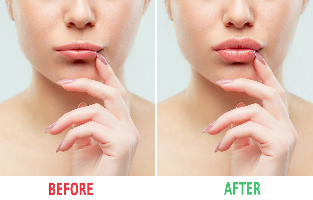 Restylane Defyne/Lyft/Refyne