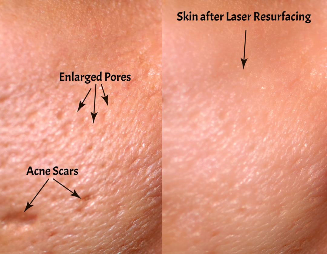 Core 2 Light Peel Series