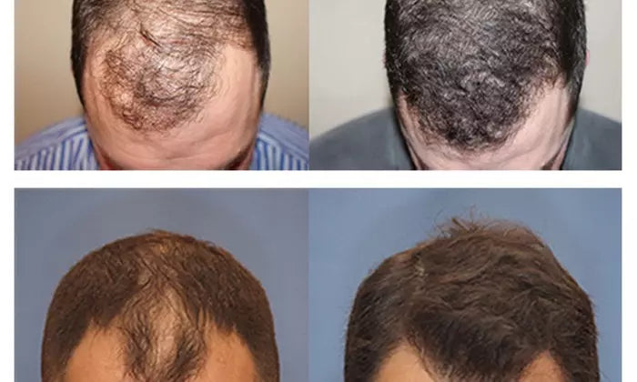 Hair Restoration with Stem Cells and Nutrafol Supplementation