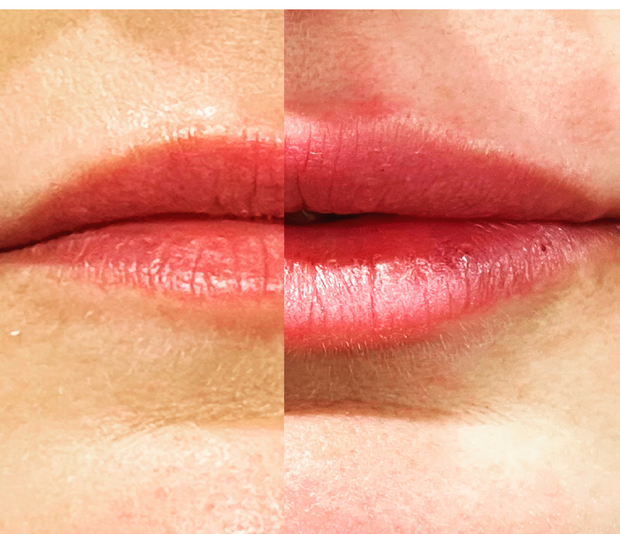 Lip filler
