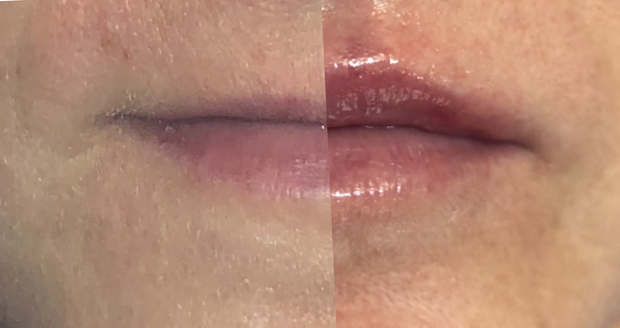 Subtle lip refresh