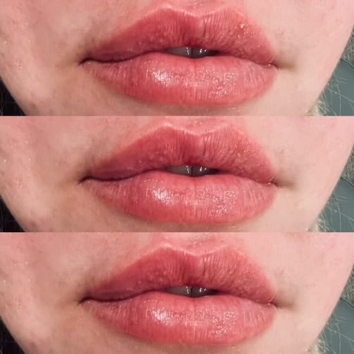 Lip filler — healed progression
