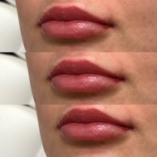Lip filler — healed progression