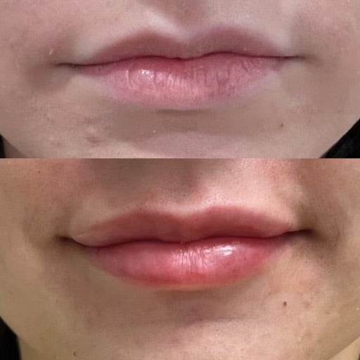 Lip filler