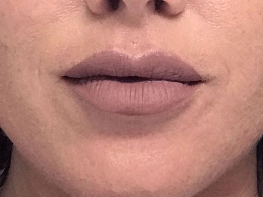 After — Dermal filler — lips & lines