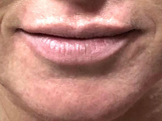 Before — Dermal filler — lips & lines