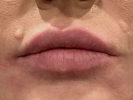 After — Lip filler