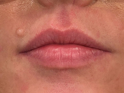 Before — Lip filler