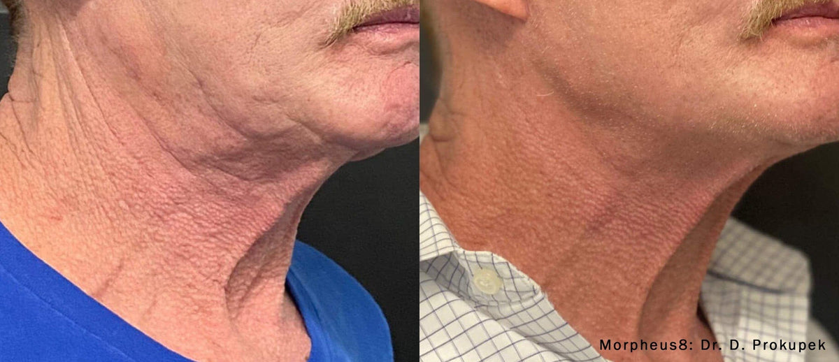 Morpheus 8 RF Microneedling Package