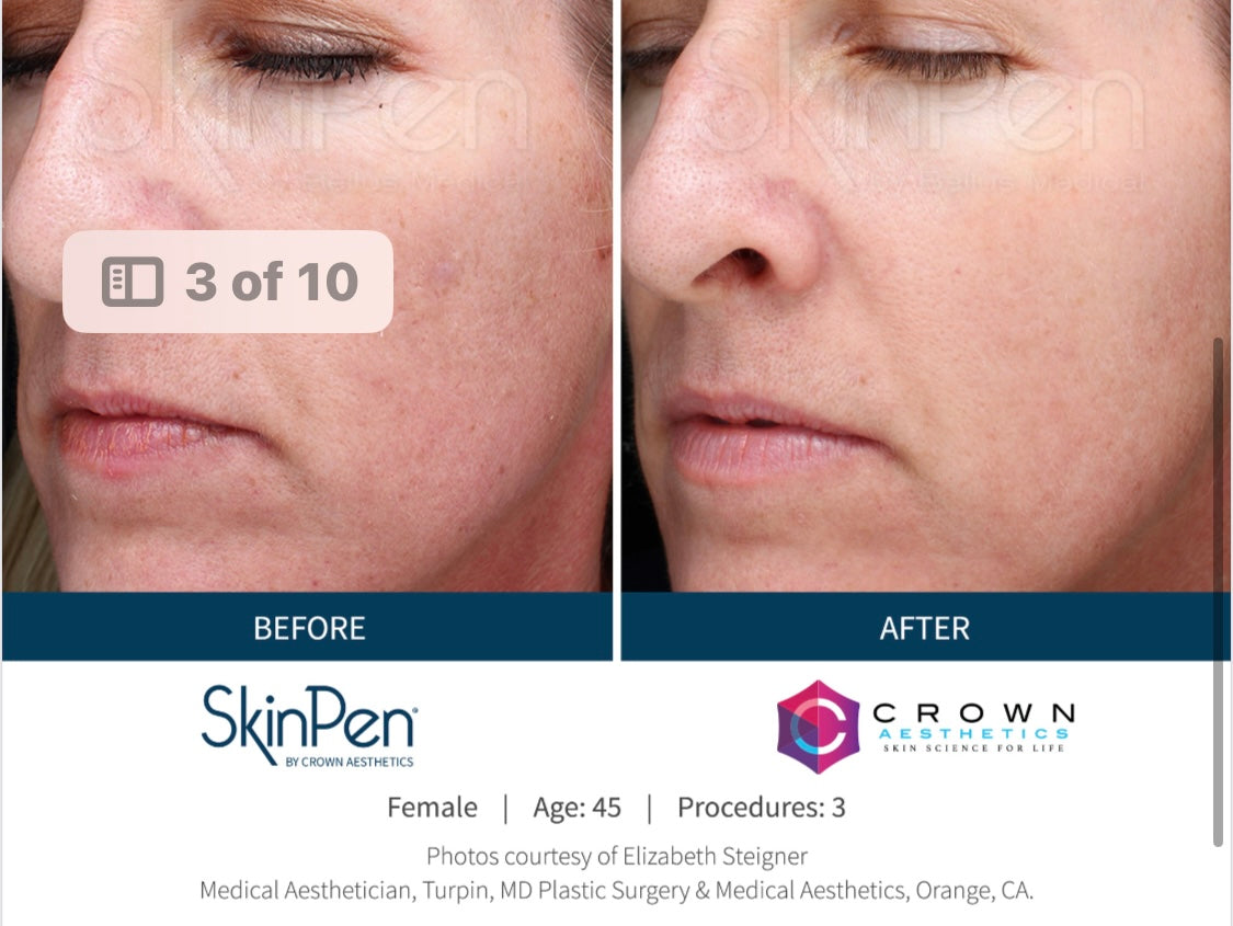 SkinPen Microneedling Session