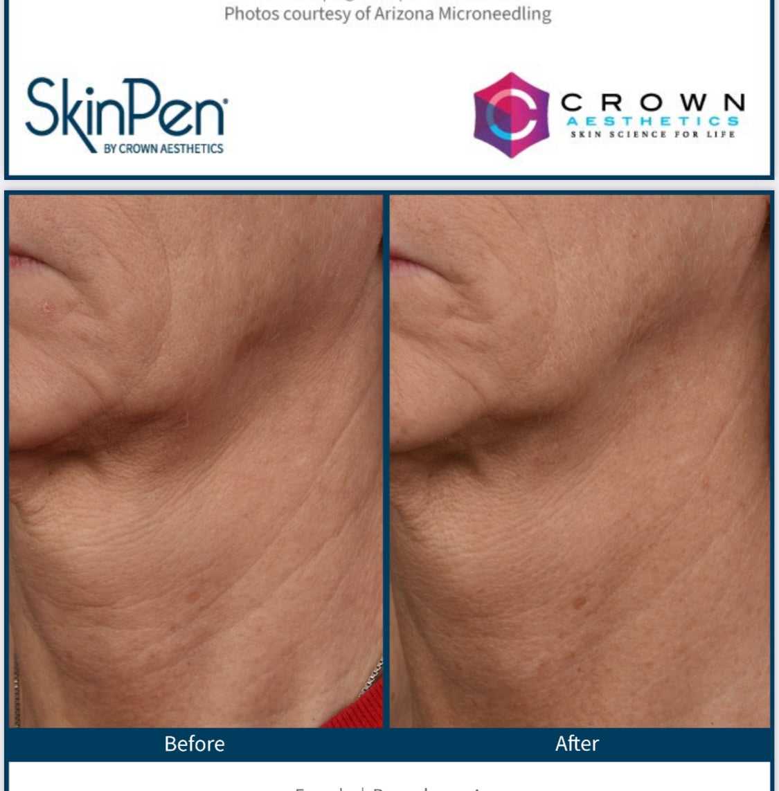 SkinPen Microneedling Package