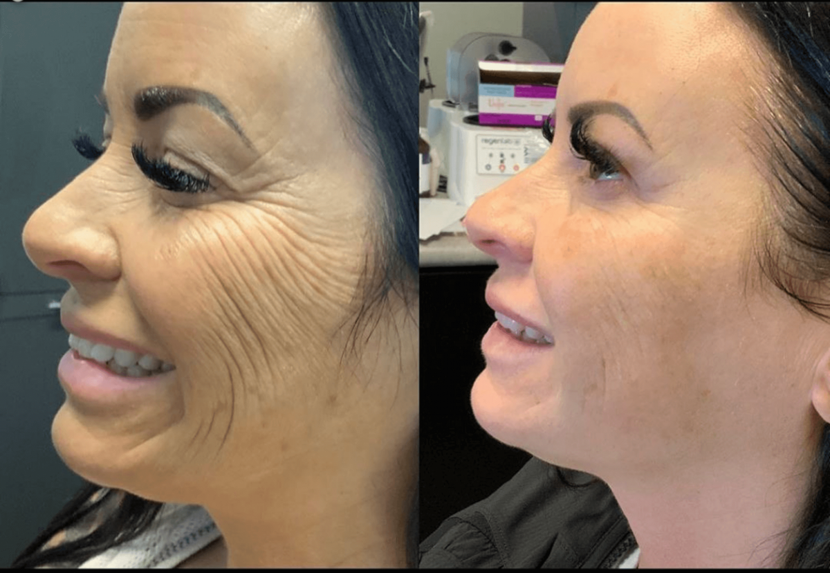 Morpheus 8 RF Microneedling Package